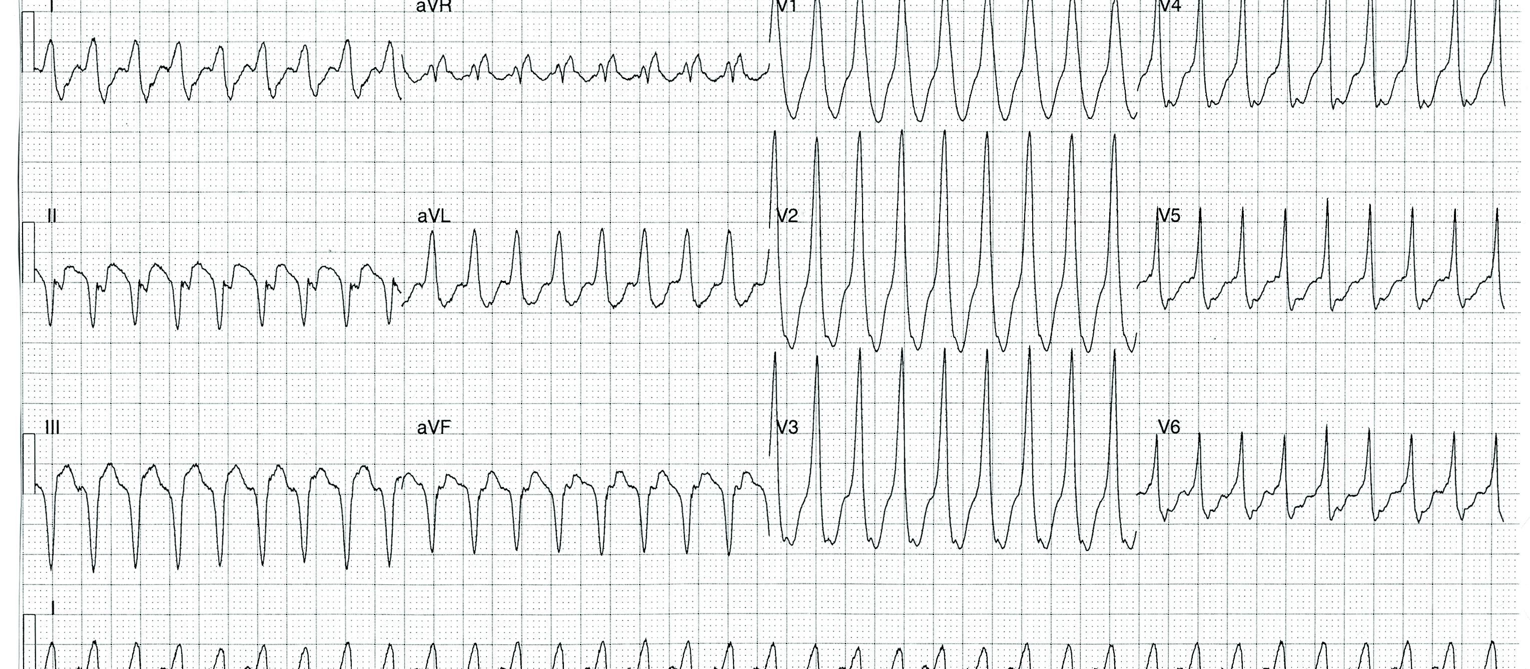 ECG