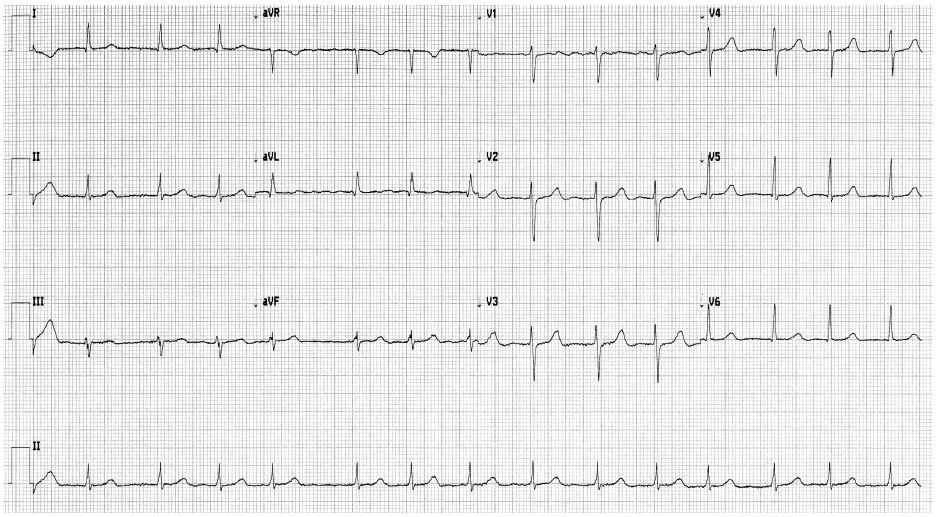 ECG 30 aug 2017