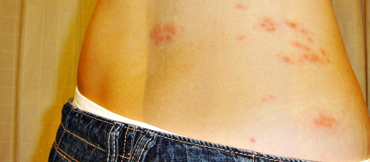 herpes_zoster_shingles