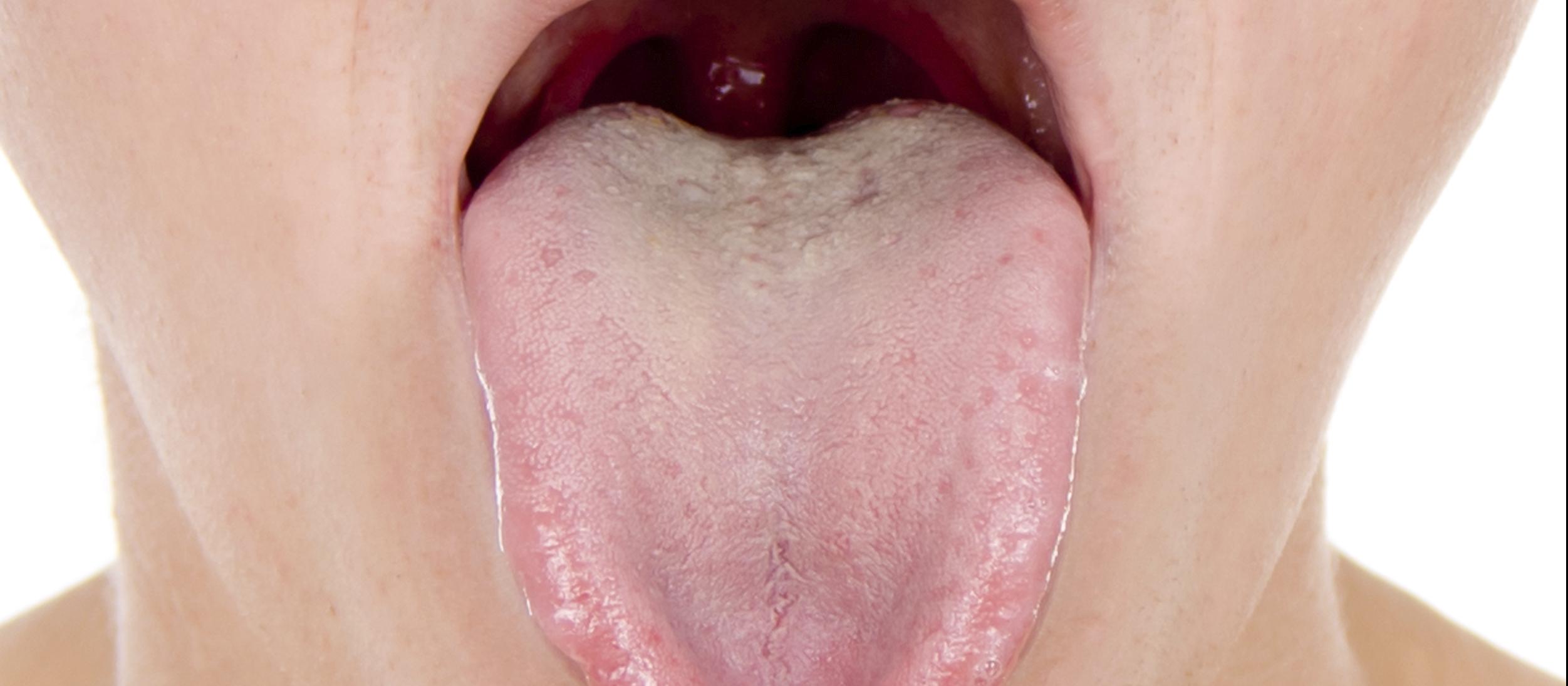 sore throat