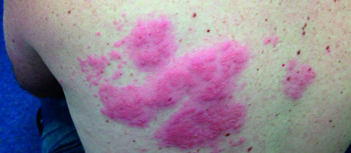 Shingles