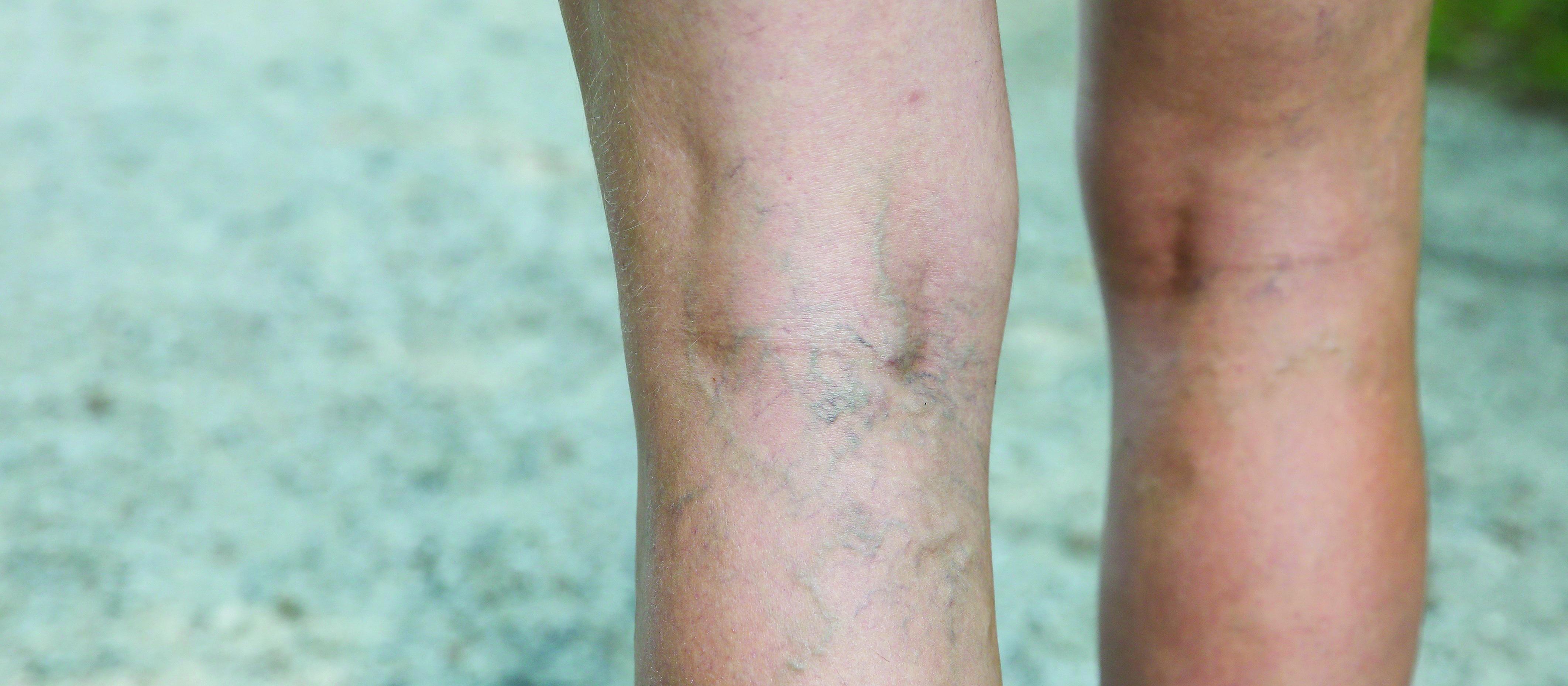 varicose veins