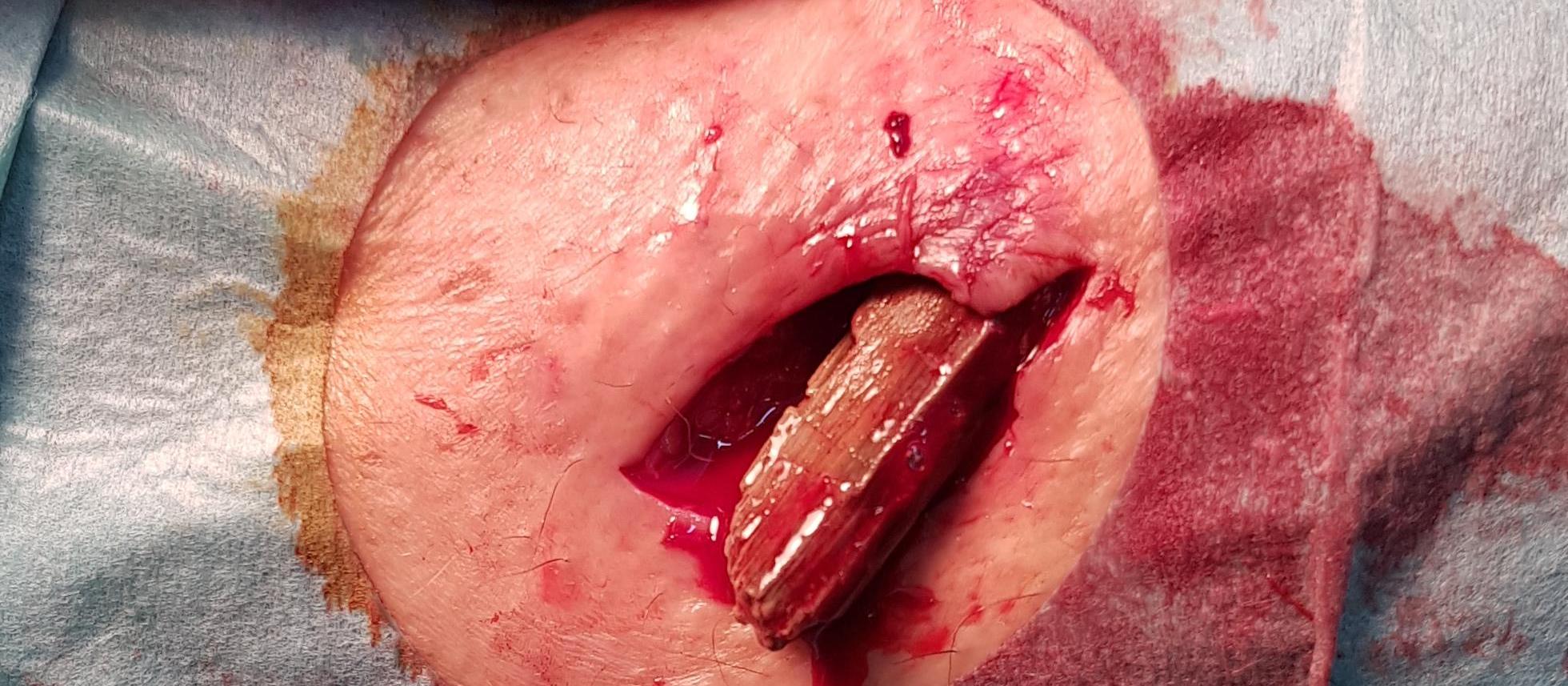 4cm x 1.5cm piece of wood removed from knee