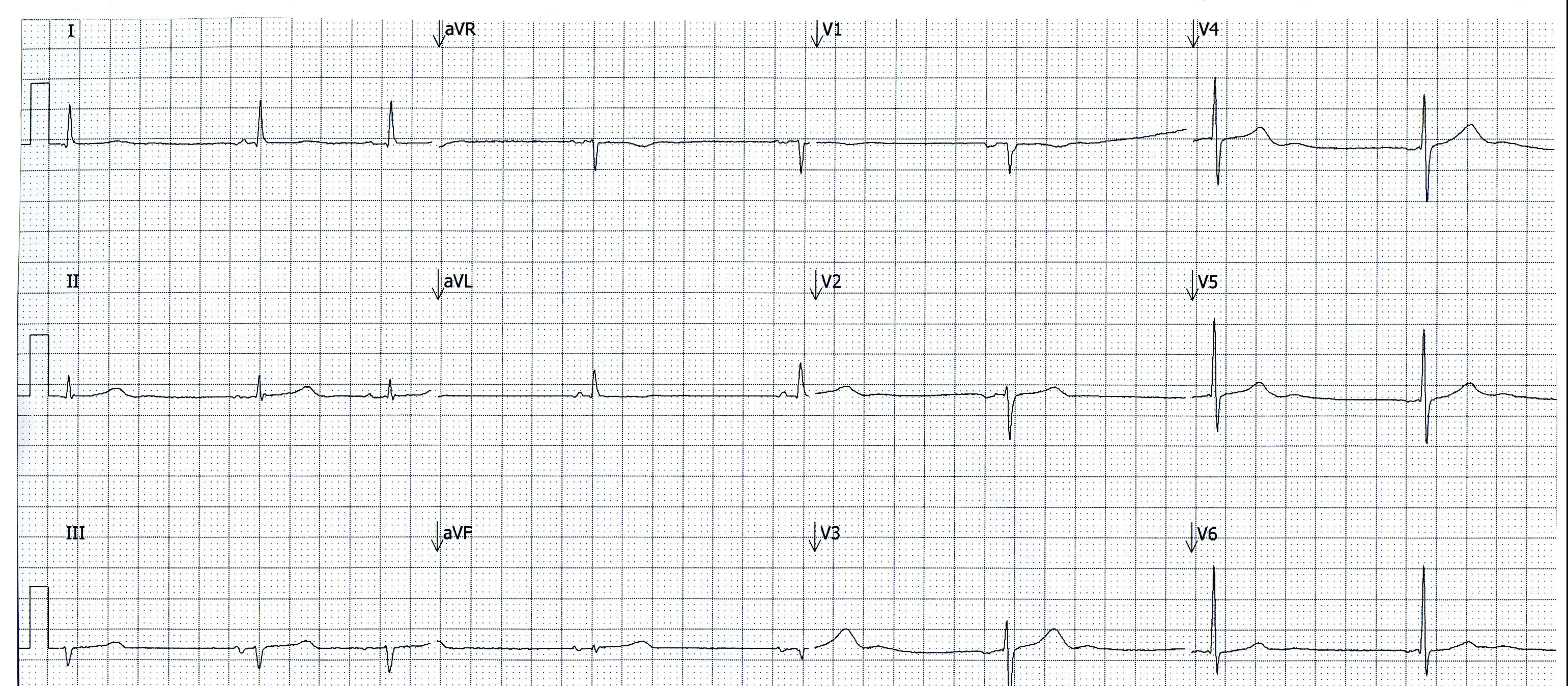 ECG
