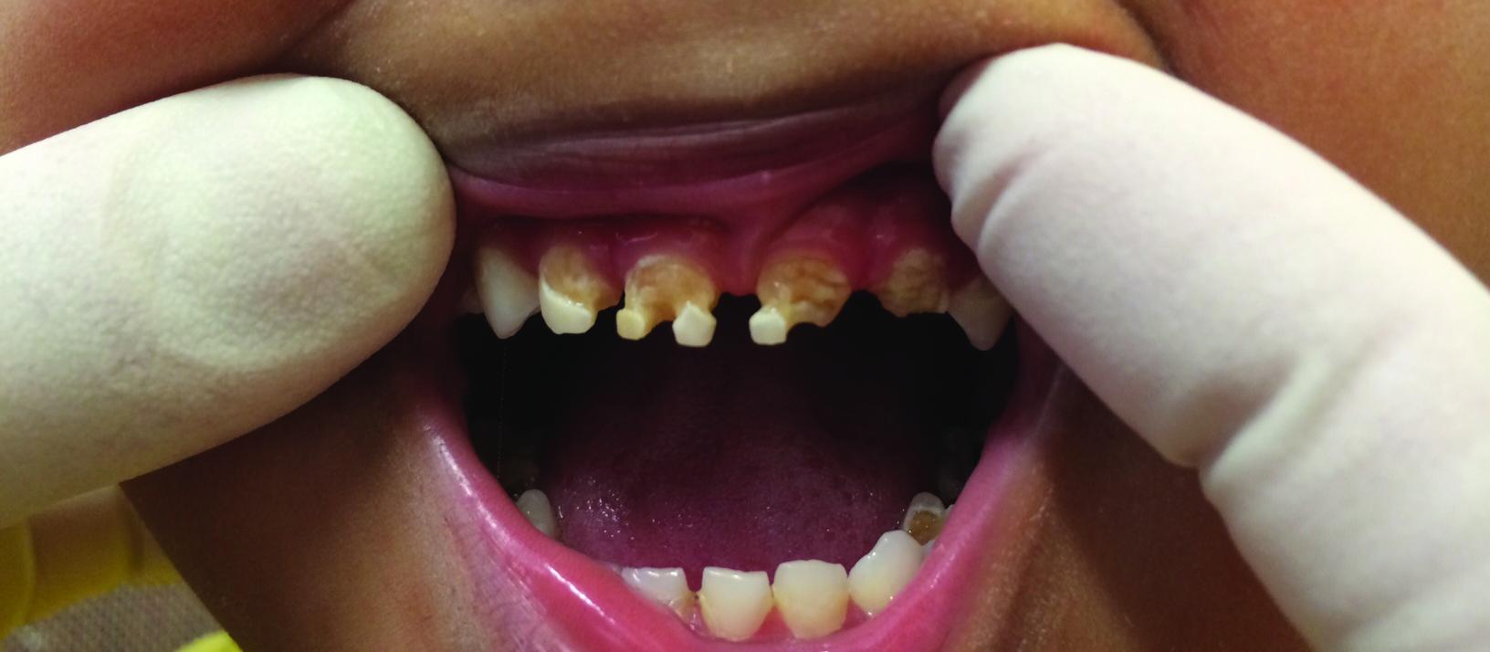 Rotten baby teeth
