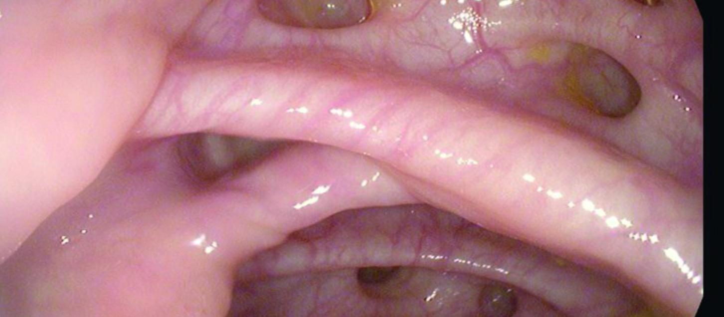Sigmoid diverticular disease