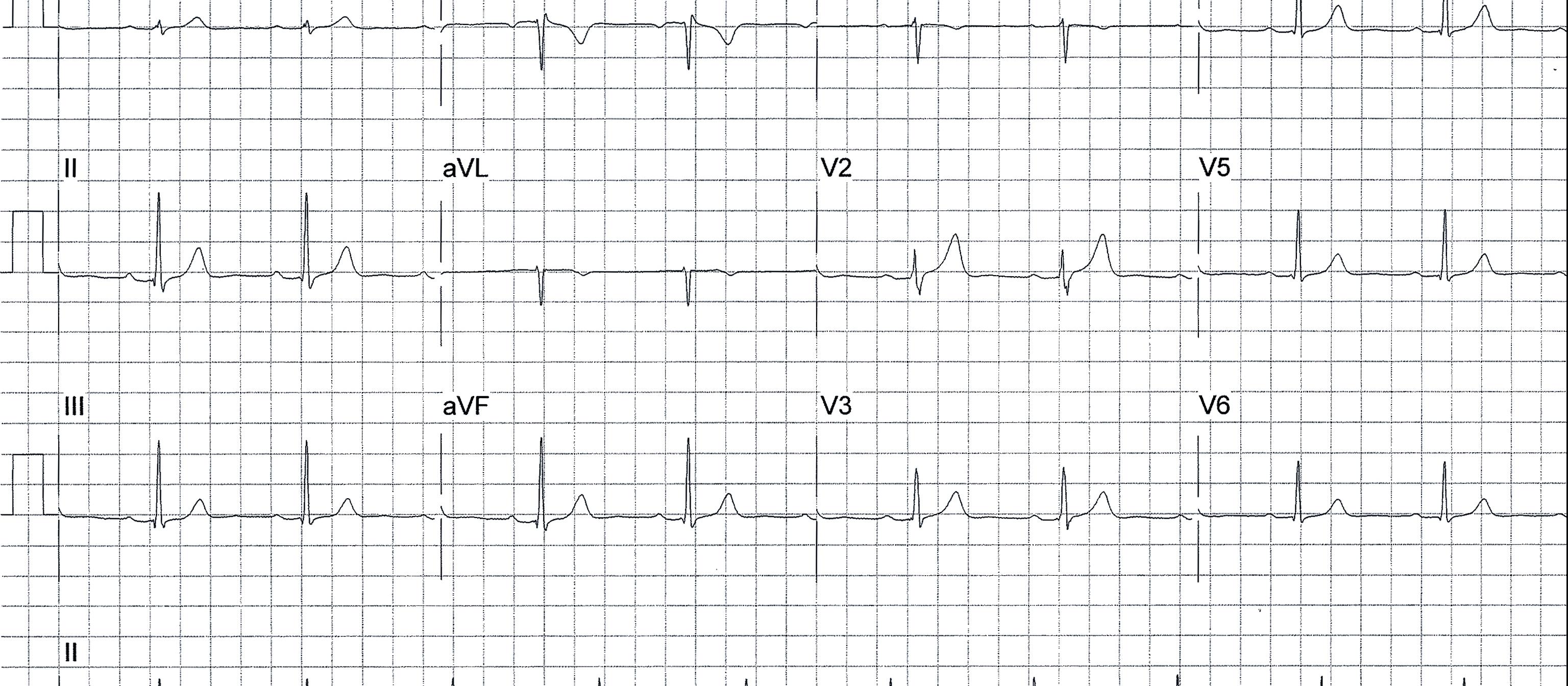 ECG 4 July