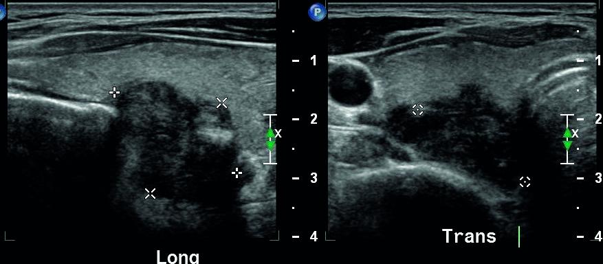 Posteriorly based right thyroid nodule