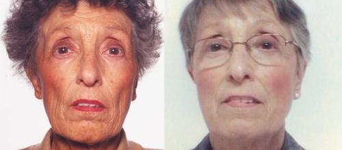  The Patient's Facial Appearance at Presentation versus after Treatment. Facial appearance at presentation (left), showing pigmentation, and after treatment (right).© 2005 Petros Perros
