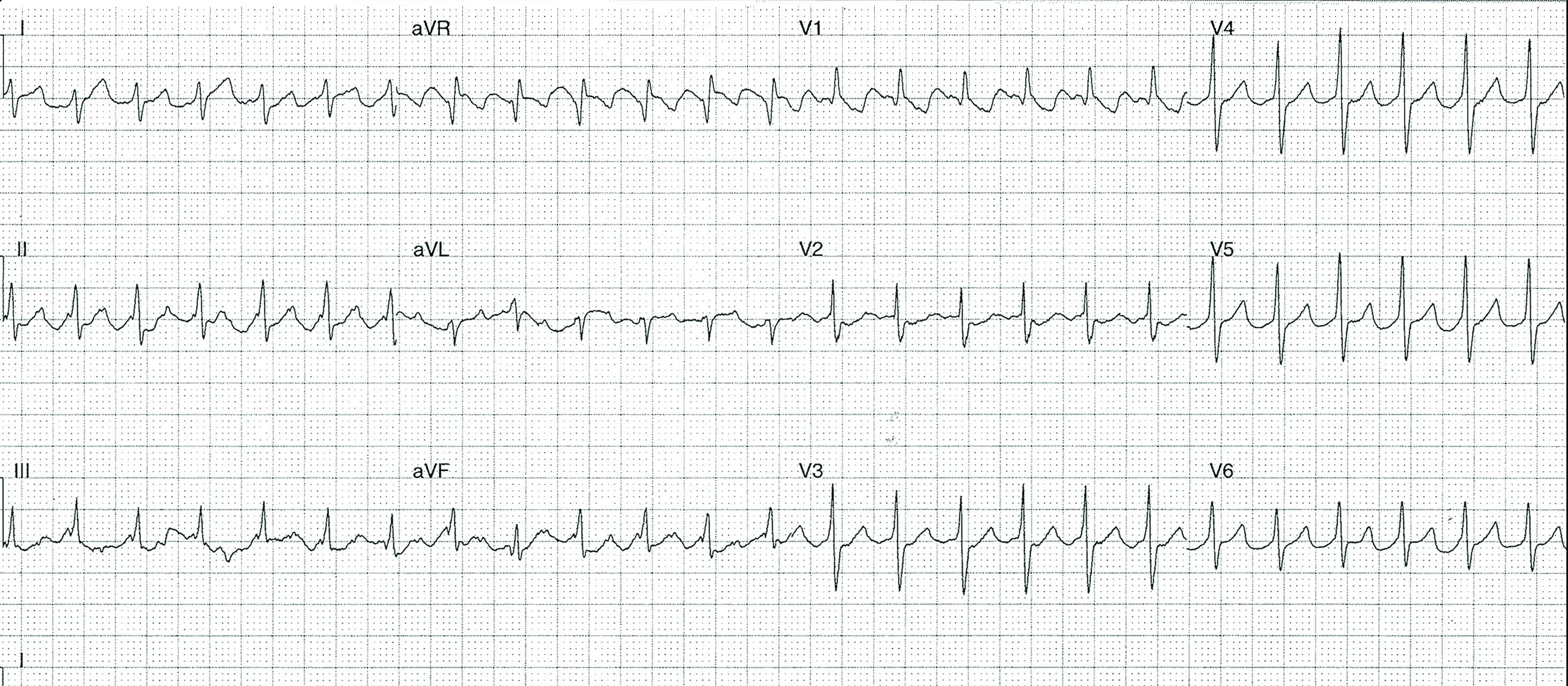 ECG heartbeat