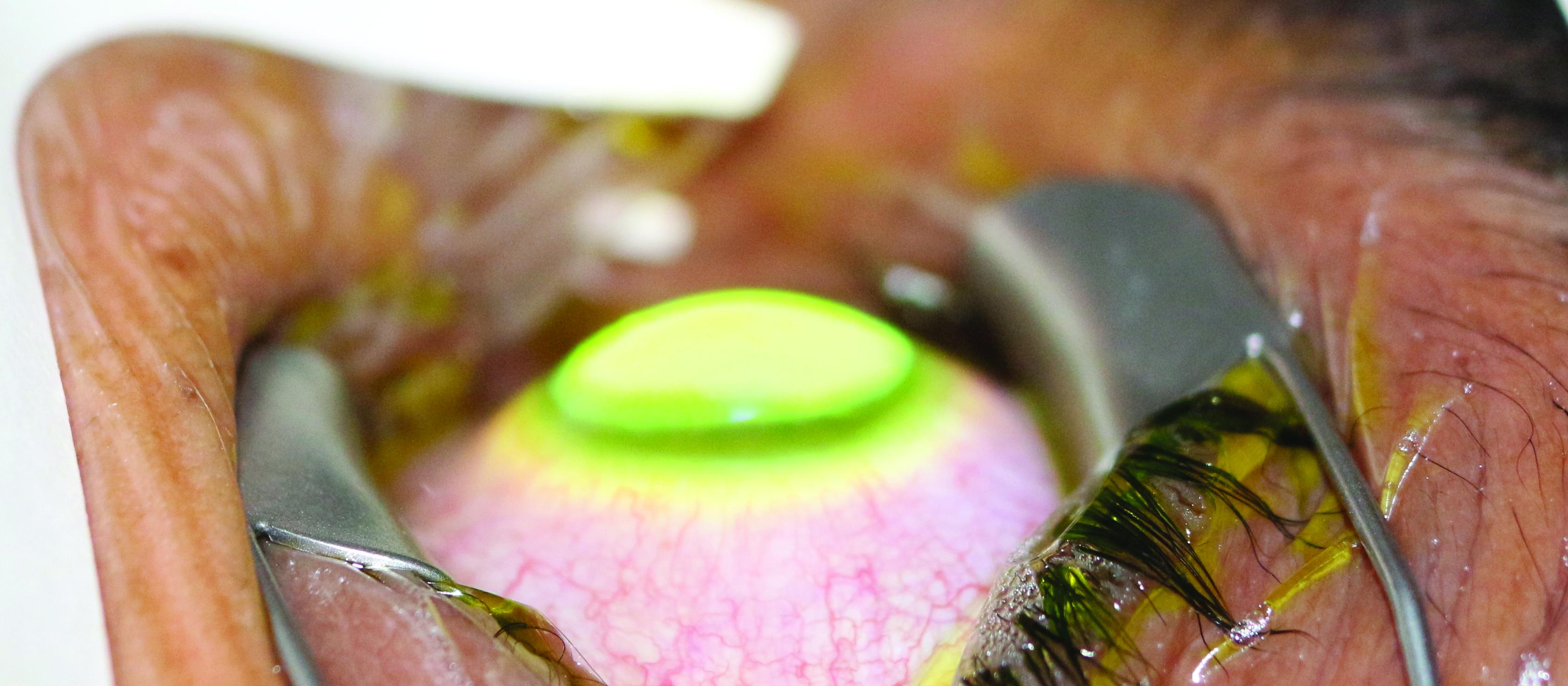 Eye