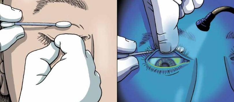 Fraser - corneal abrasions, eye injuries