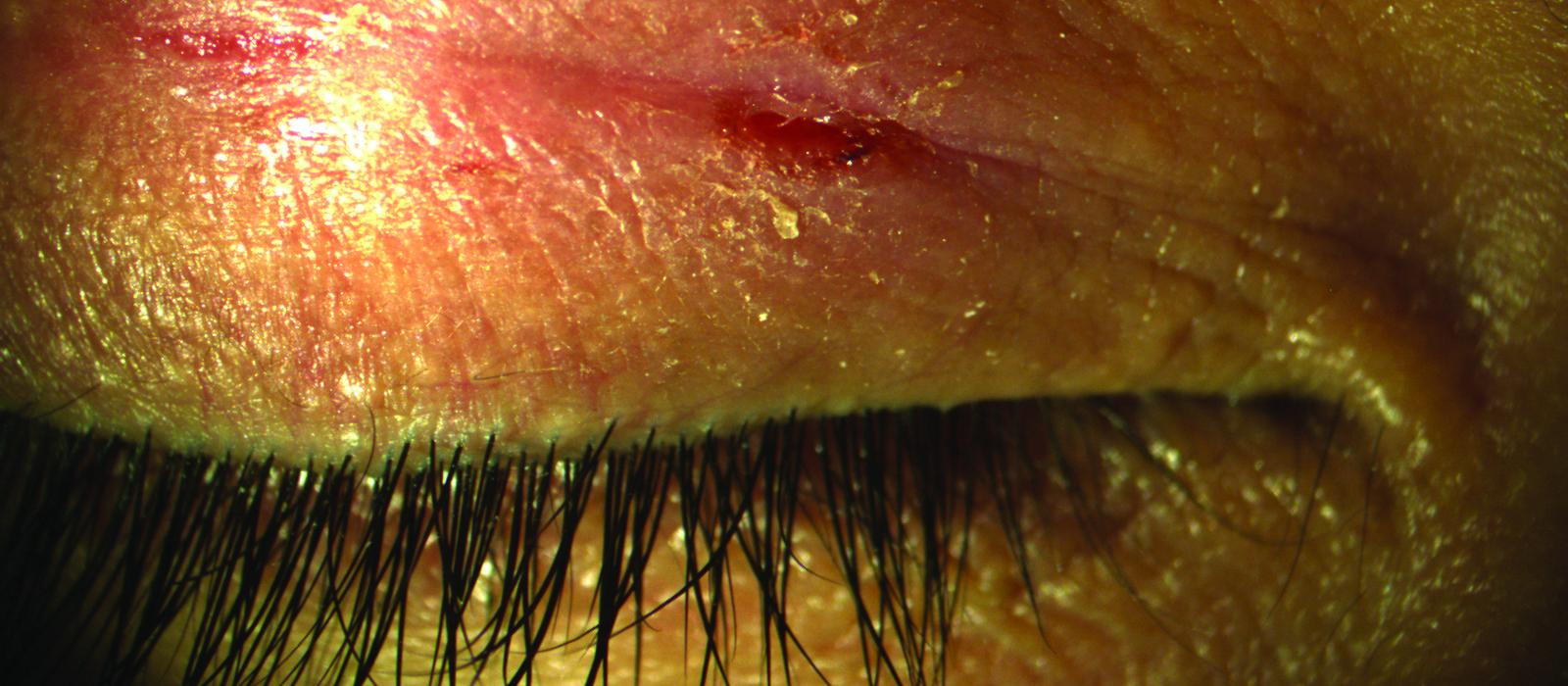 Lid dermatitis