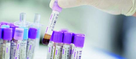 Prostate cancer test