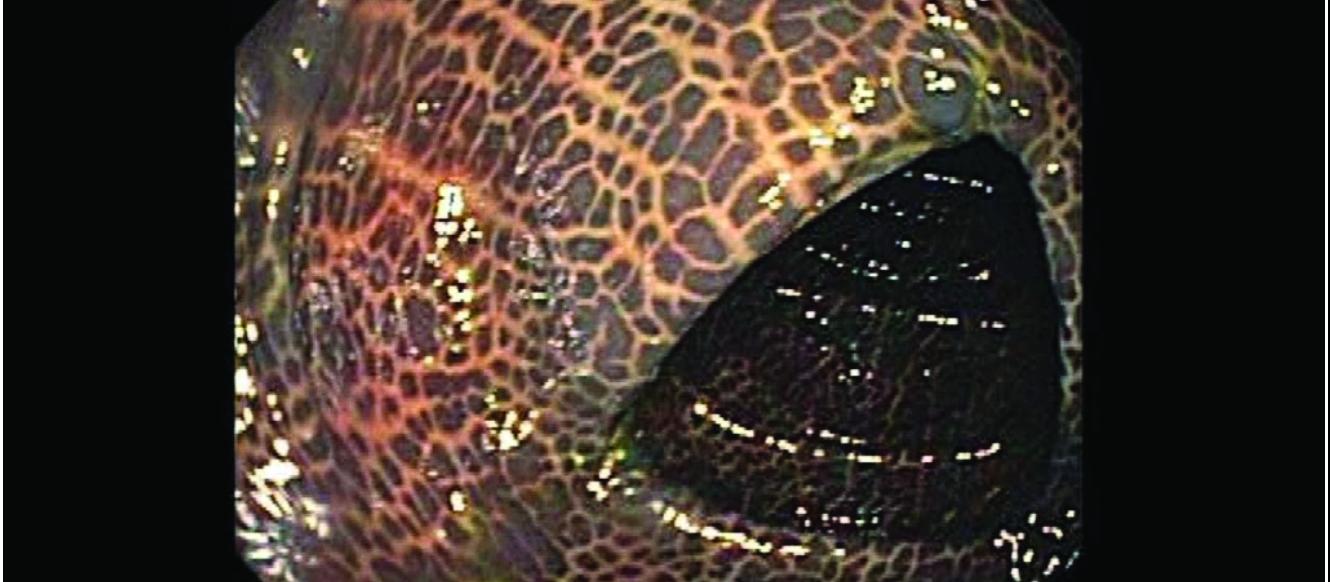 Melanosis coli