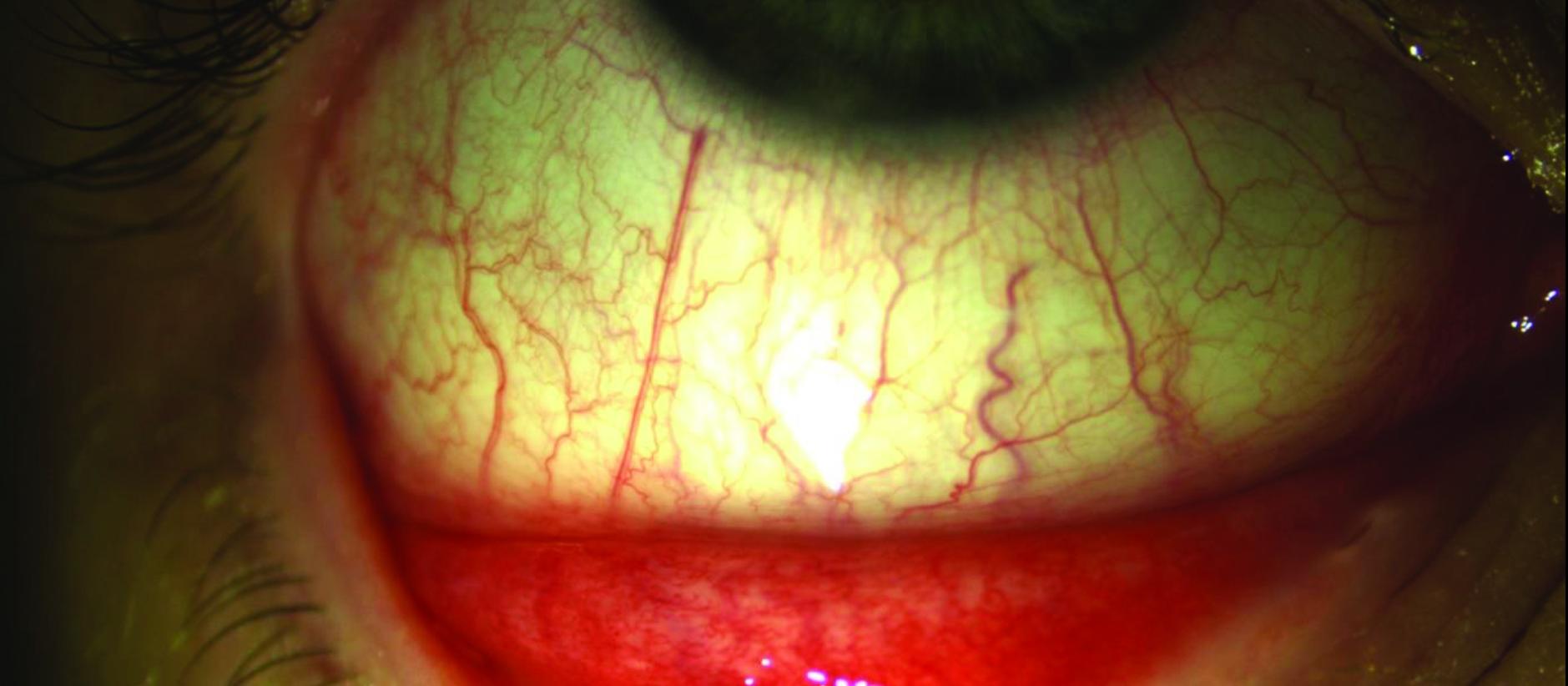 Eye