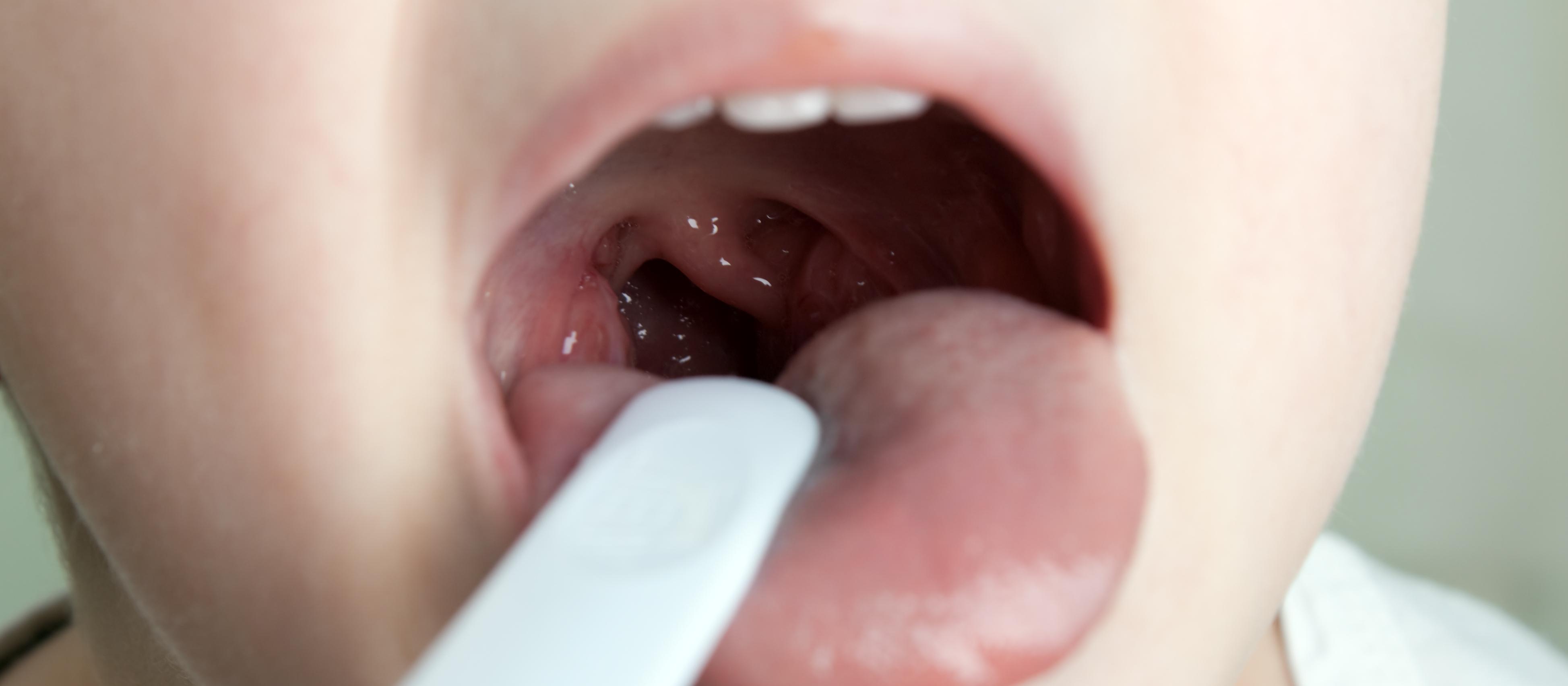 Throat_swab_child