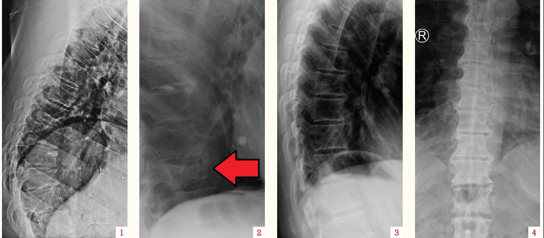 Back pain