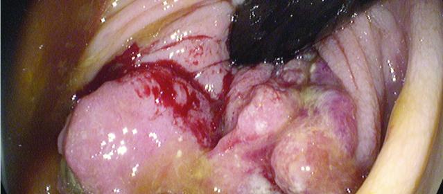 Colonoscopy