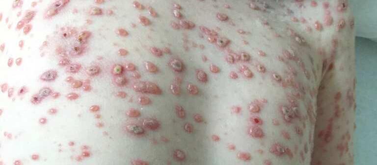 Measles patient 1 b