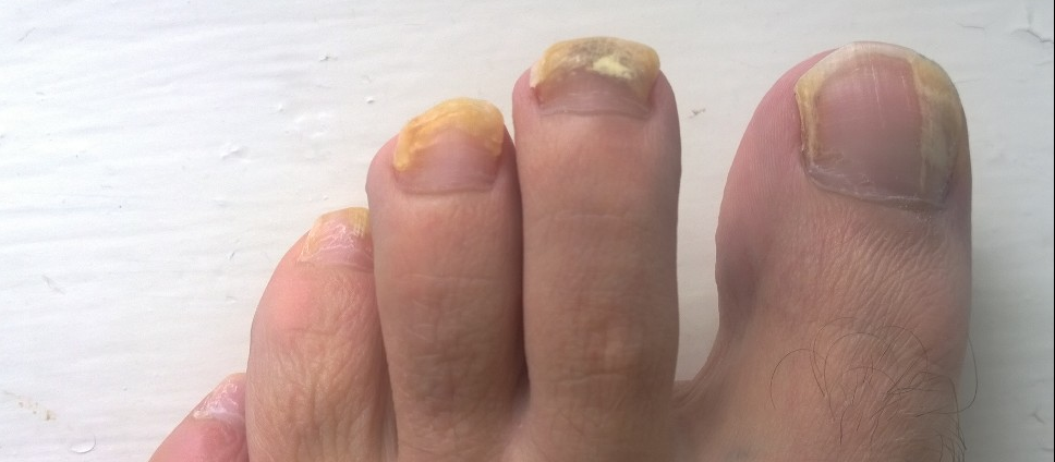 Patient's foot with a fungal nail infection 10 weeks after oral treatment
