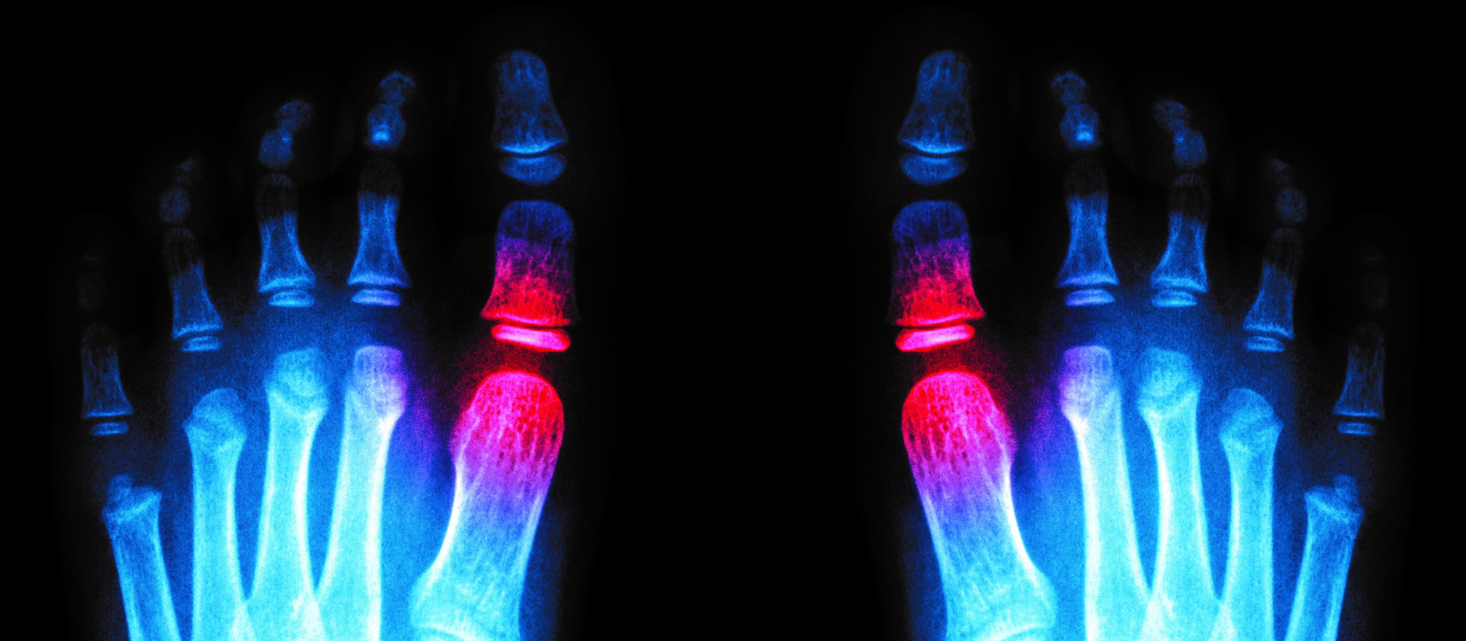 Foot X-Ray