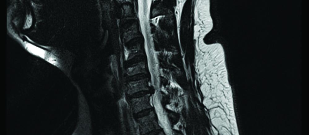 C6-C7 disc herniation