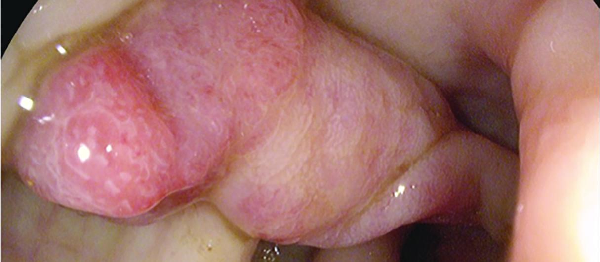 An advanced adenoma (1.5cm diameter) before polypectomy