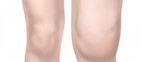 Arthritic Knee