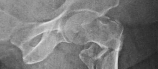 fractured hip