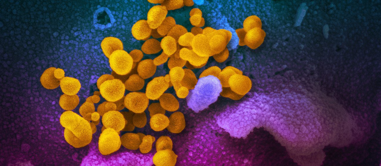 scanning electron microscope image shows SARS-CoV-2 (yellow)—also known as 2019-nCoV, the virus that causes COVID-19—isolated from a patient in the U.S., emerging from the surface of cells (blue/pink) cultured in the lab.  source us national institutes of health 