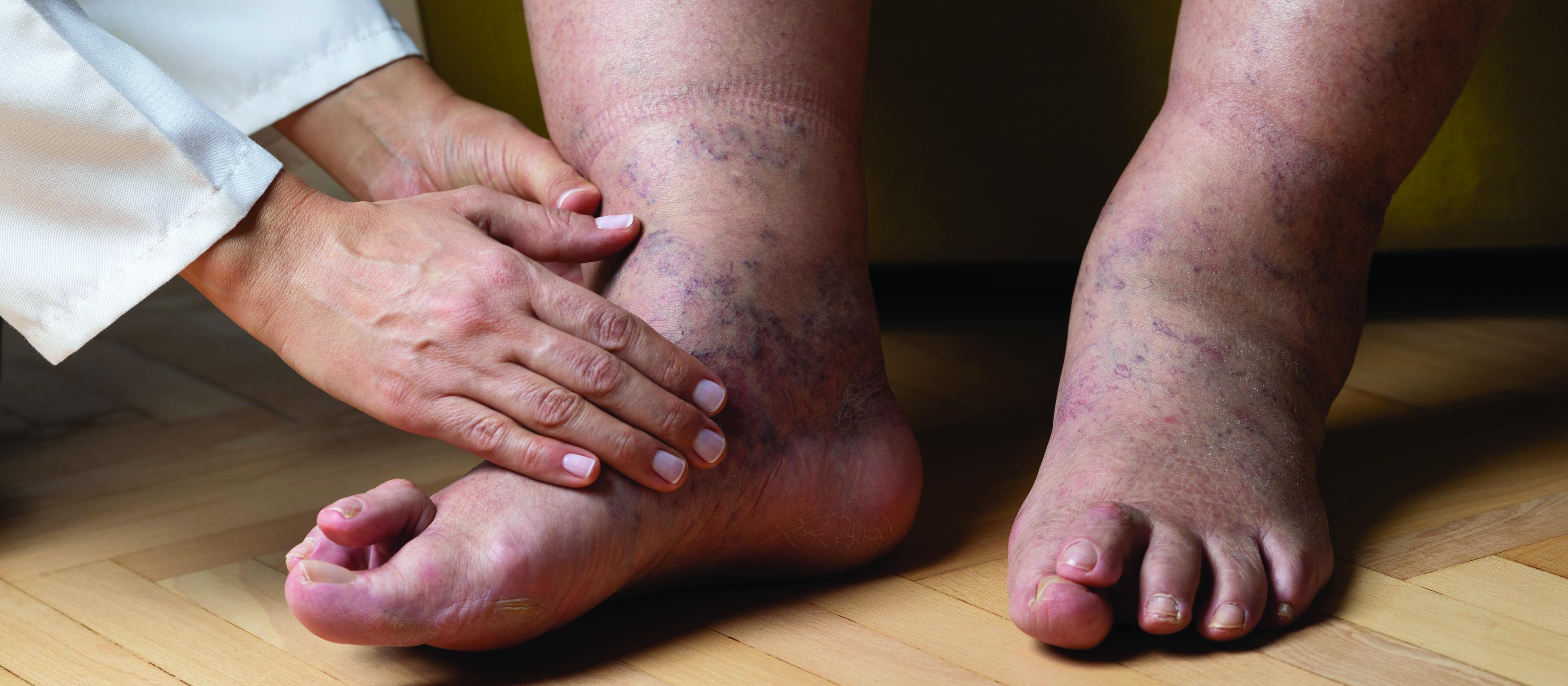 Oedema swollen