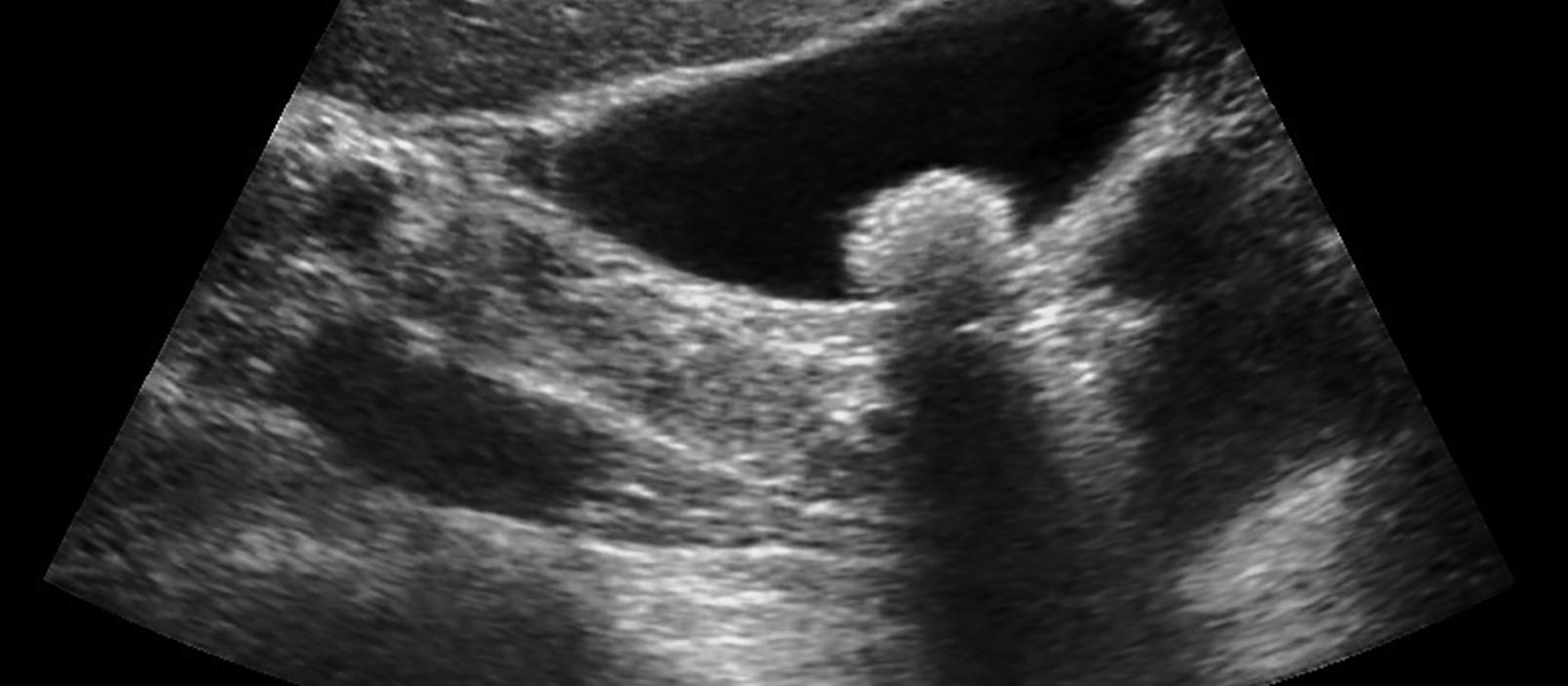 Ultrasound of gallbladder
