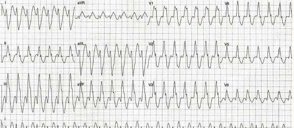 ECG heartbeat 0107