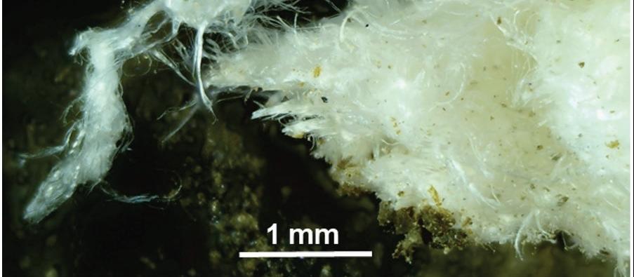 causas de un derrame cerebral hemorragico