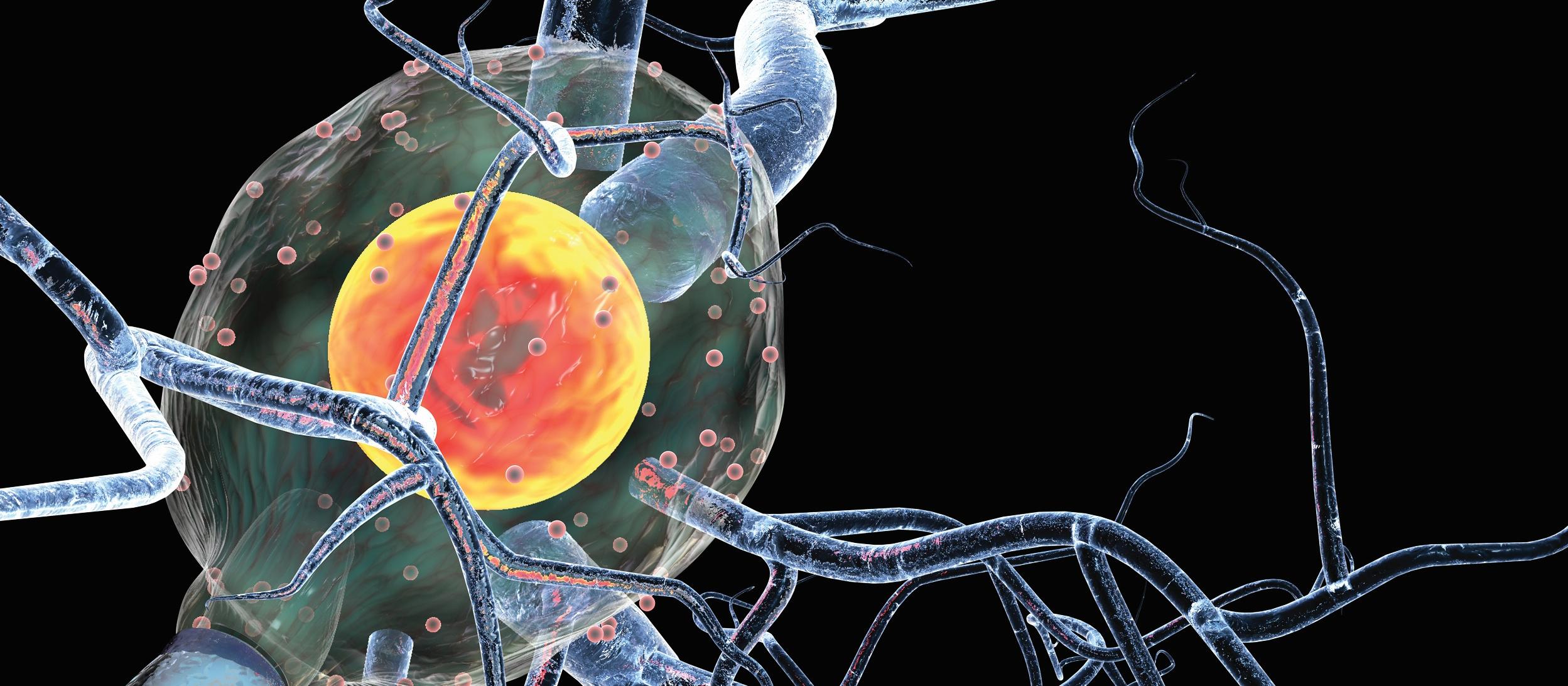 multiple sclerosis