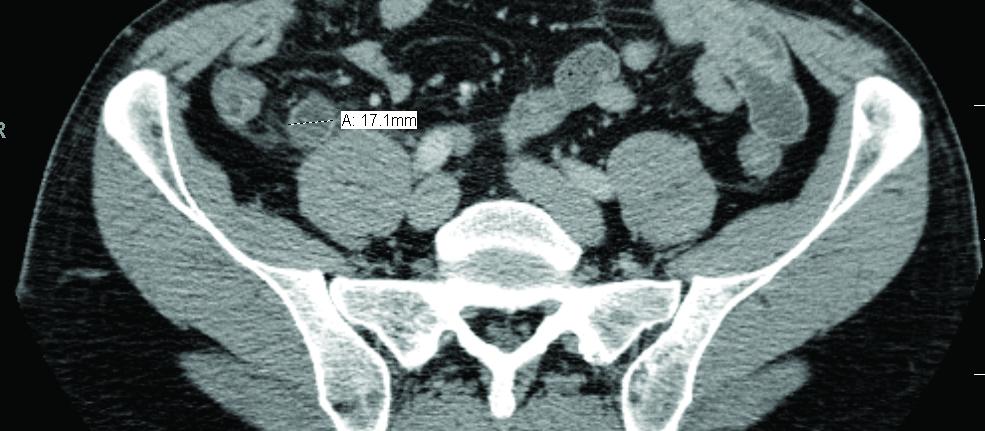 CT scan showing acute appendicitis
