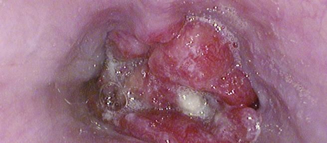 Adenocarcinoma
