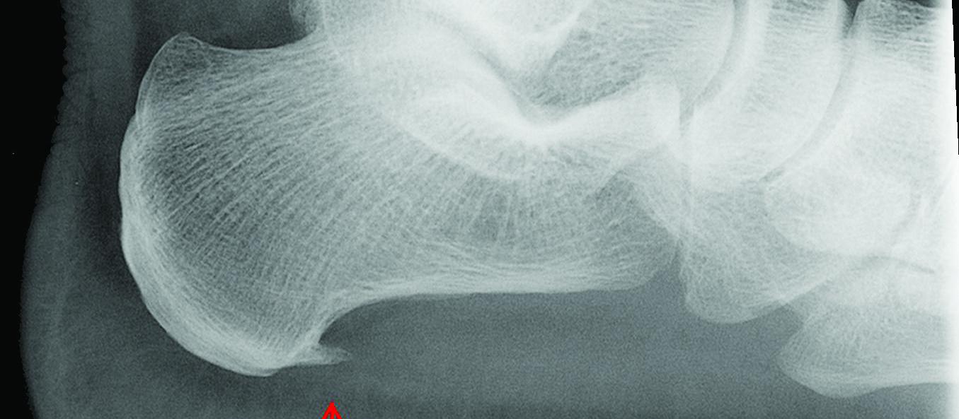 Plantar fasciopathy, sports medicine, injury