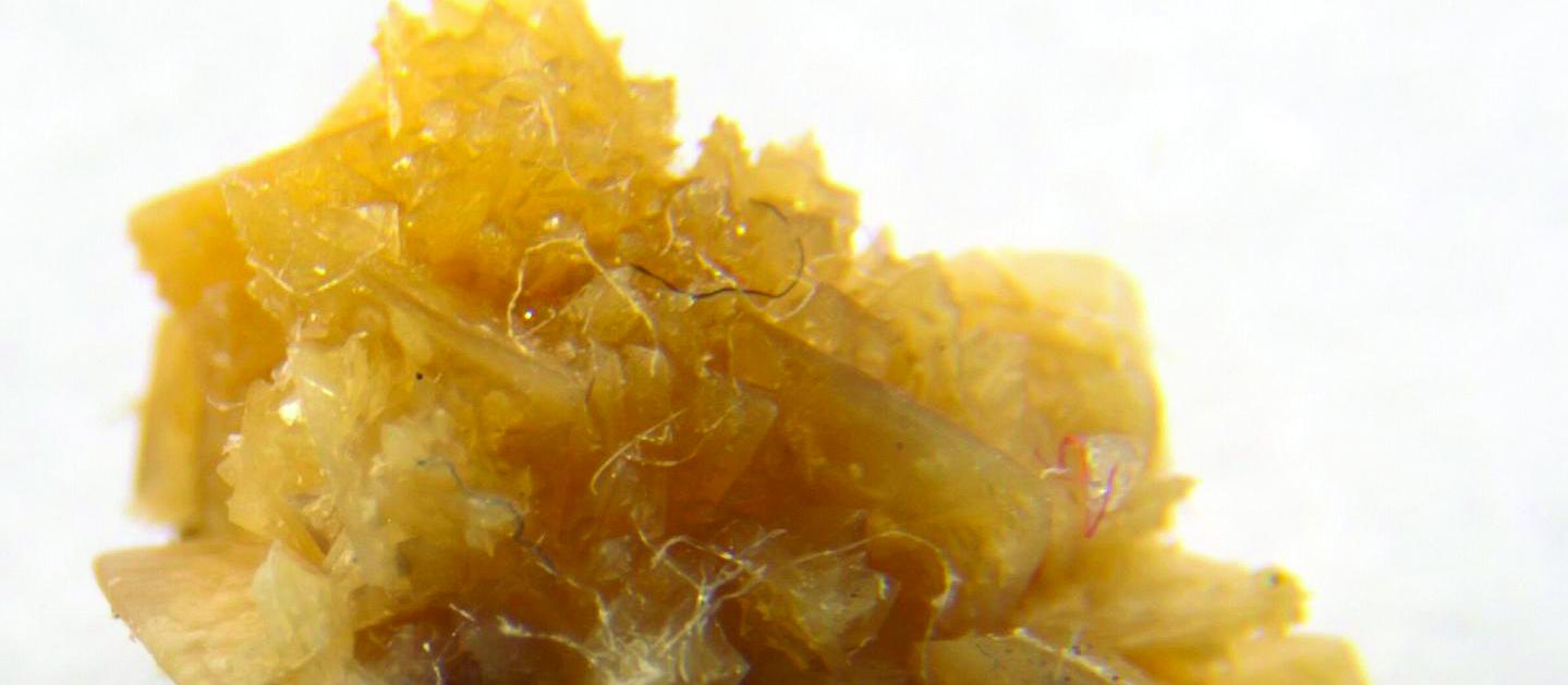 Kidney stone