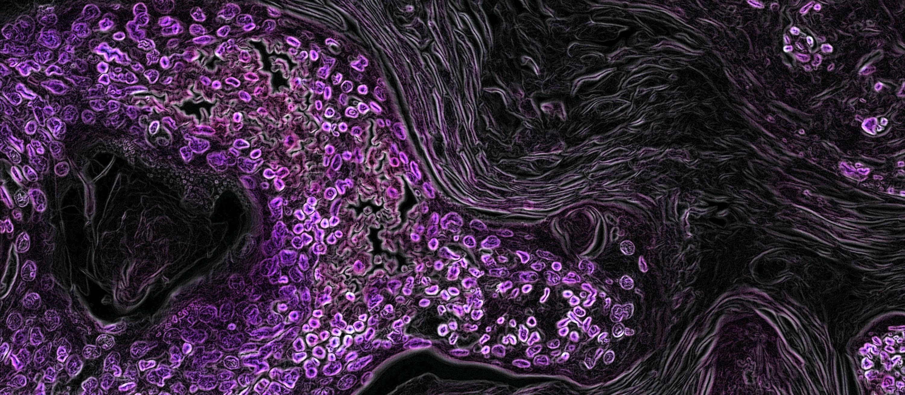 Lung cancer cells