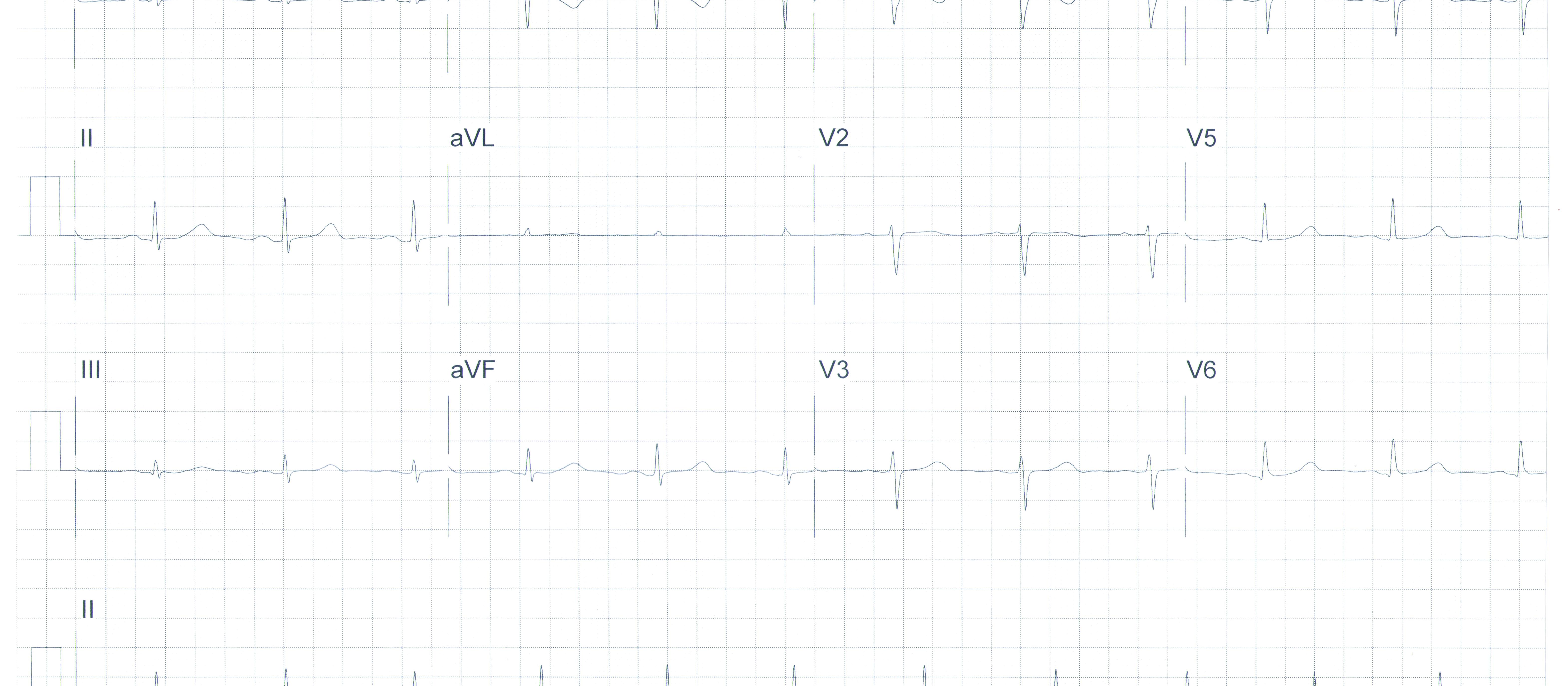 Heartbeat ECG 03032021