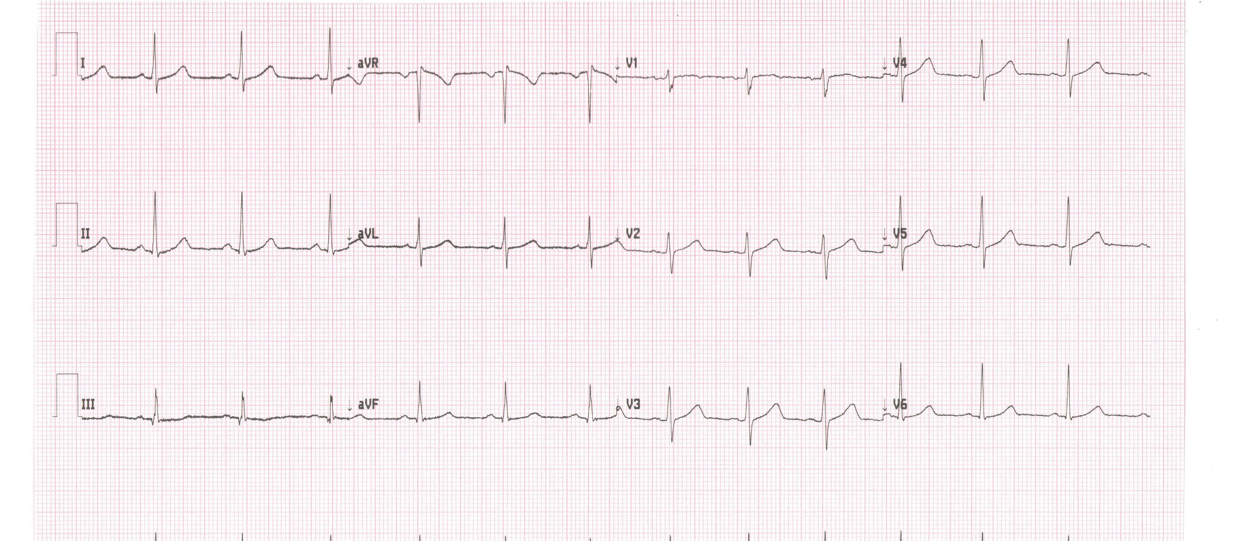 ECG