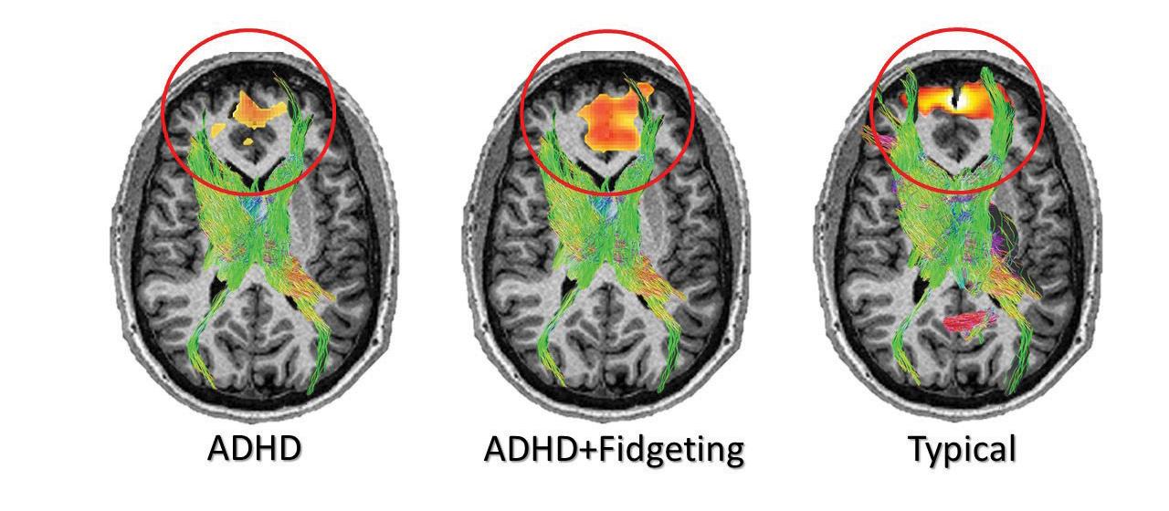 ADHD Brain MRI scan