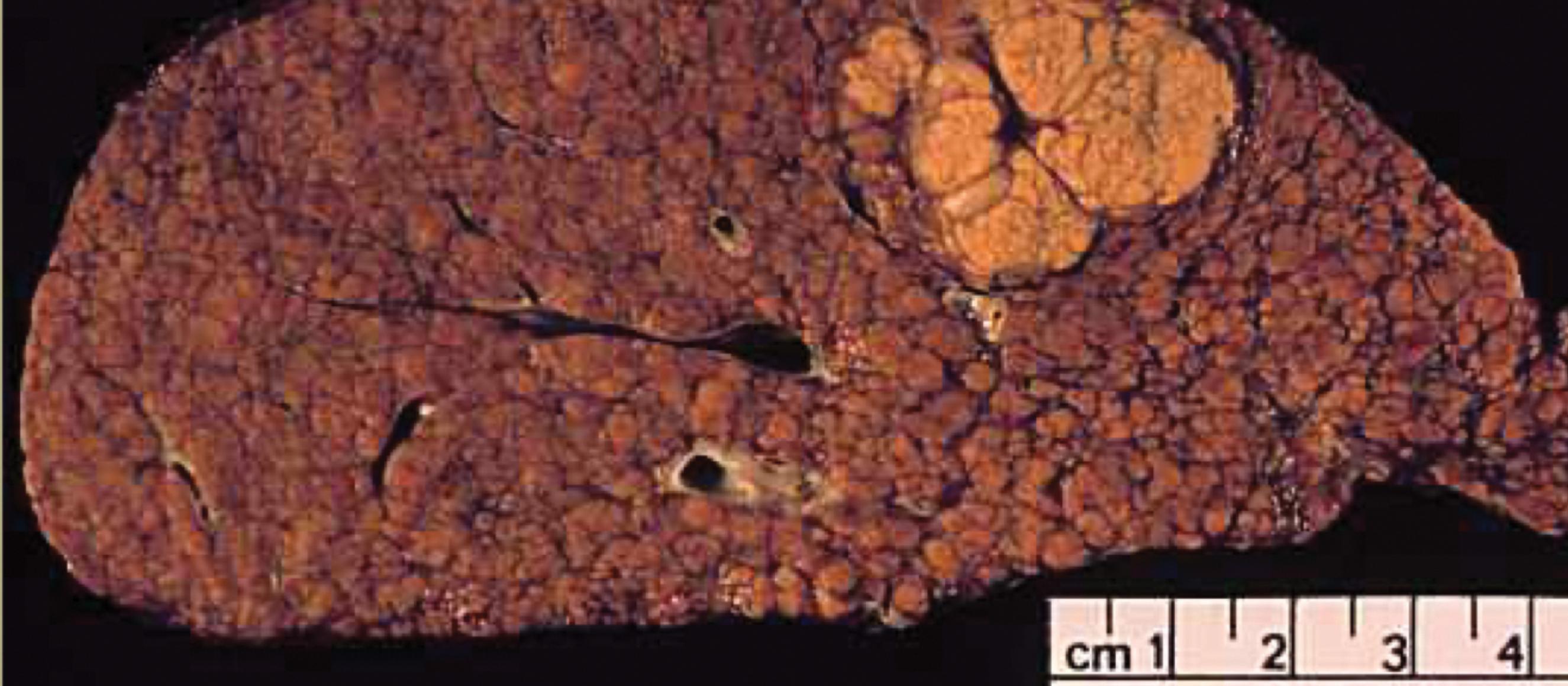 hepatocellular-carcinoma-organ