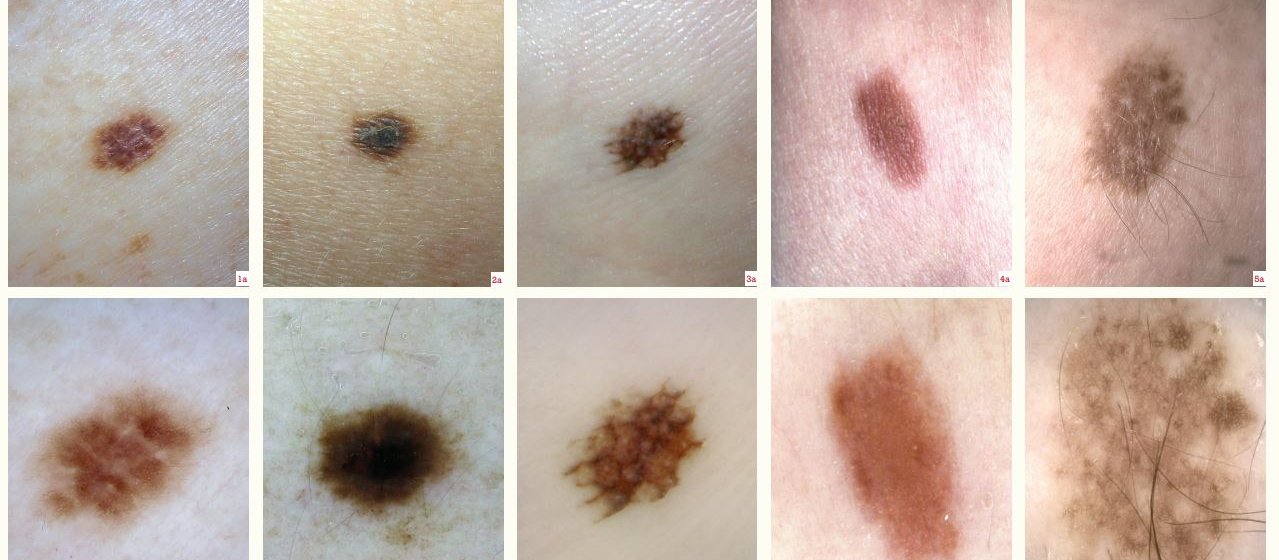 Dermatoscopic examination 1