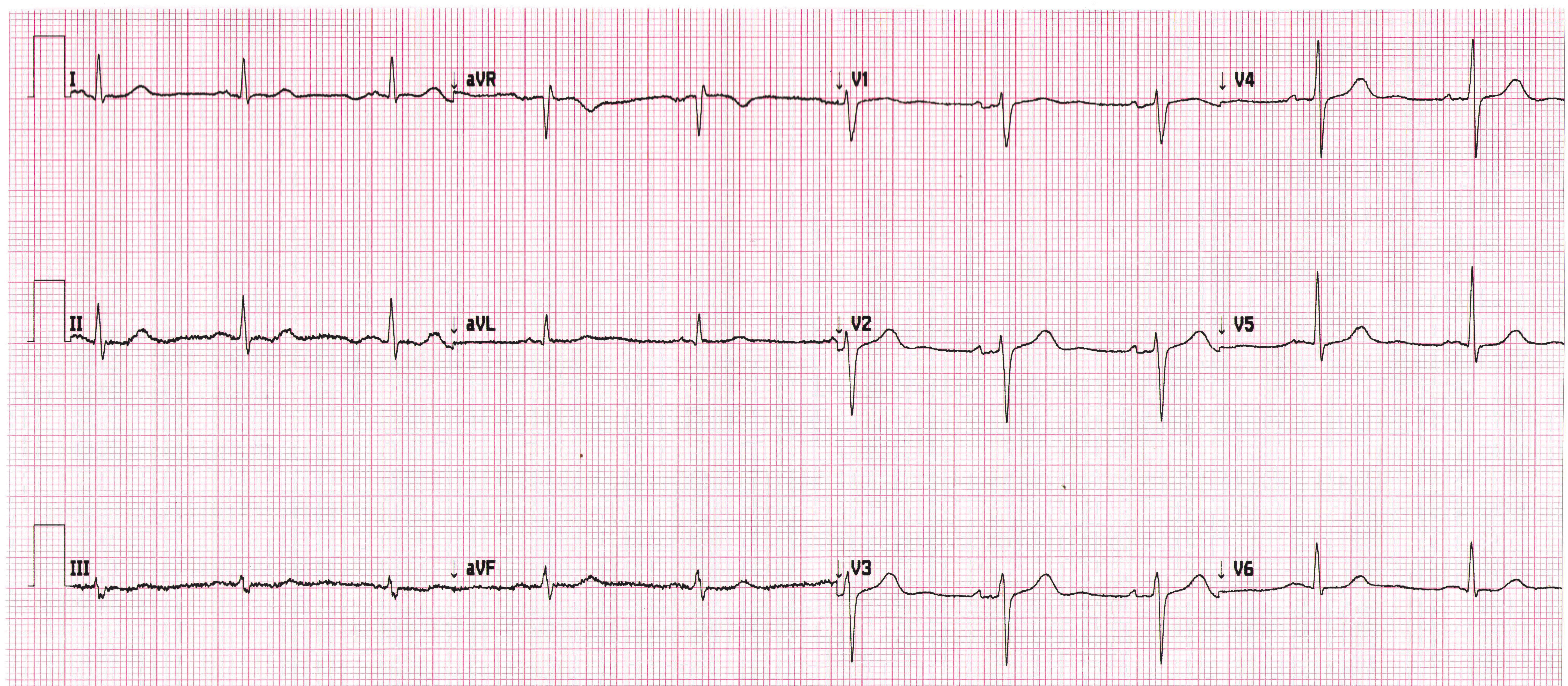 Heartbeat 