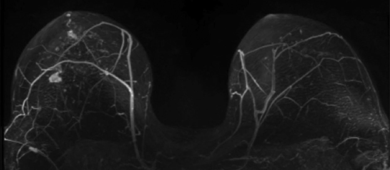 Abbreviated breast MRI showing a multifocal invasive lobular cancer in the left breast
