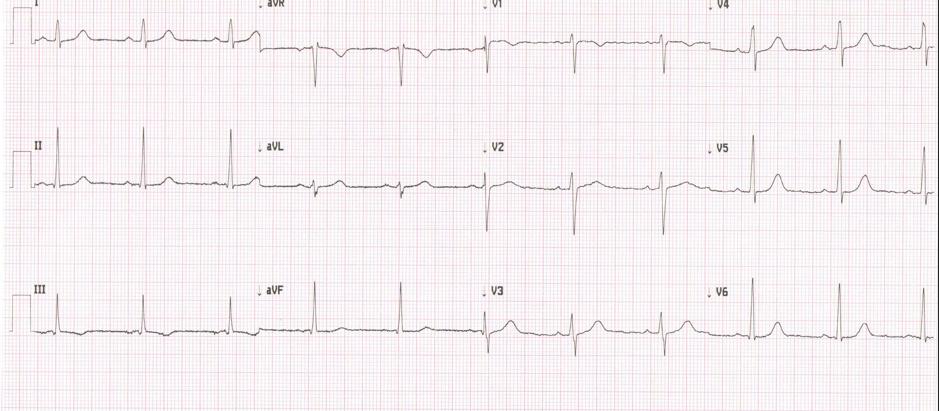 Heartbeat ECG