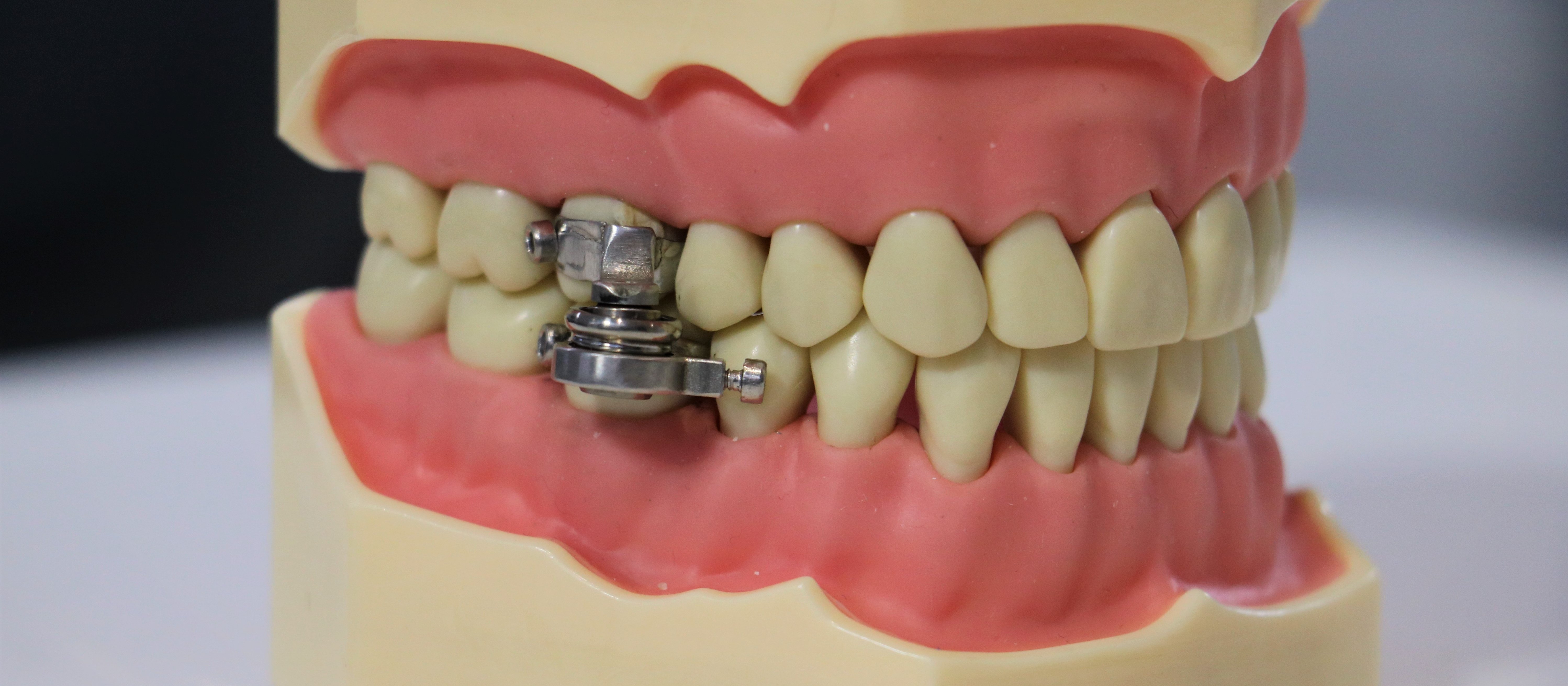 weight loss dental implement
